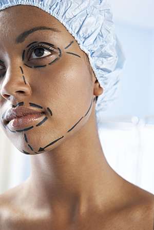 Plastic surgery incision lines drawn on a young girl’s face before a facelift.